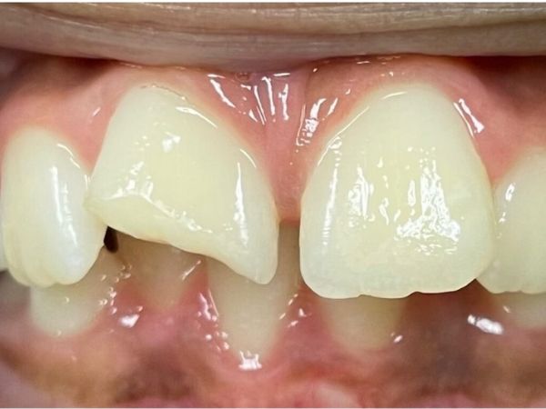 Before pediatric dentistry treatment